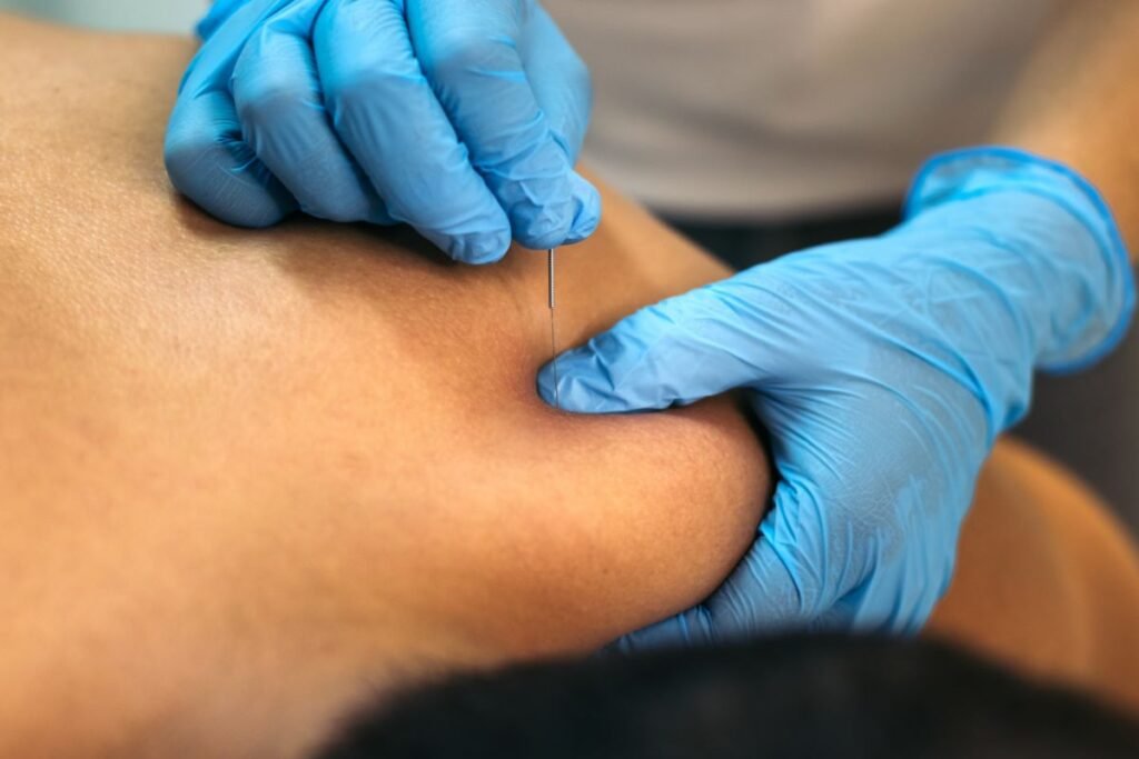 Benefits of Dry Needling Therapy