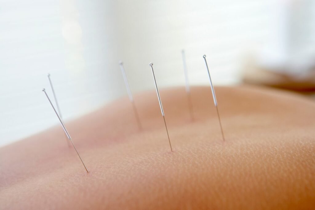 How Dry Needling Works