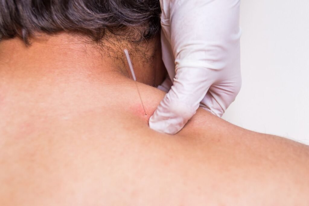 What is Dry Needling